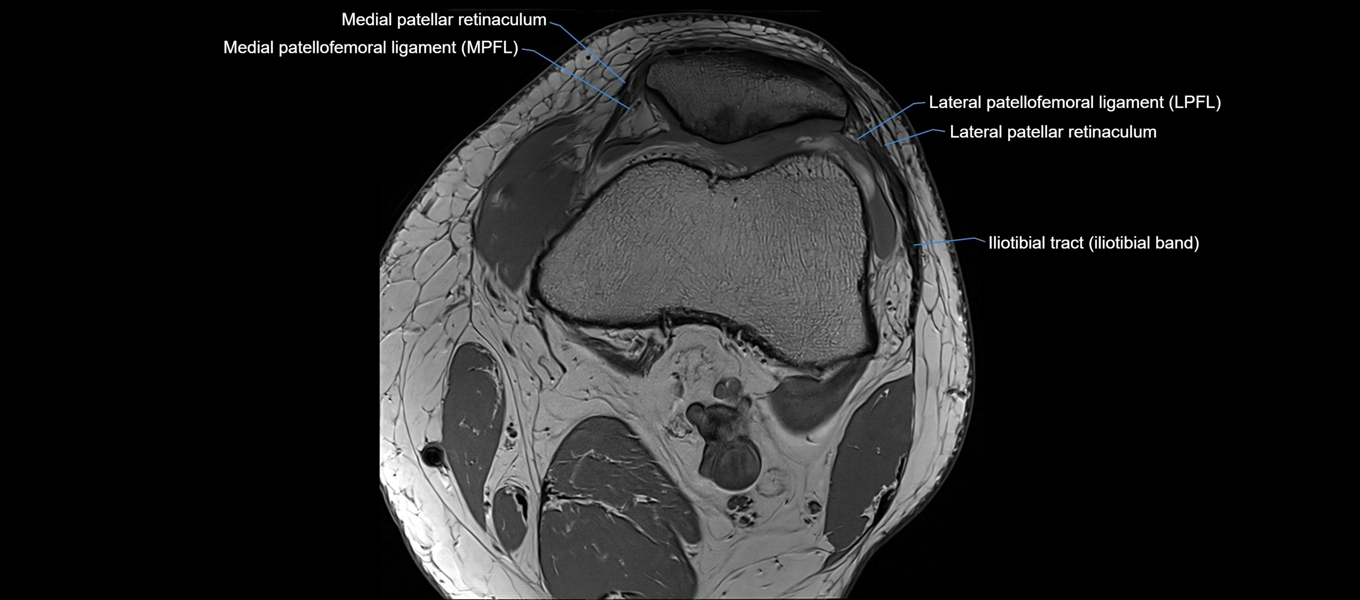 MRI Knee axial  ligaments cross sectional anatomy 3T  radiology  image-img-03001-00013.webp